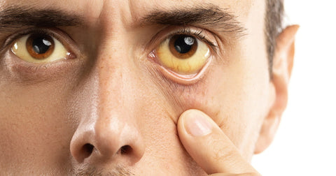 Decoding Yellow Skin: Insights into Jaundice Causes and Implications
