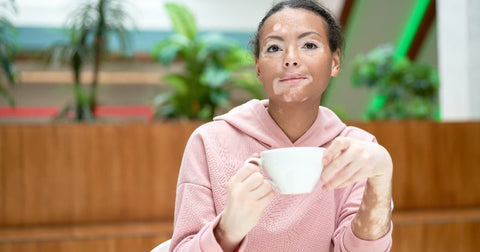 Does Coffee Cause Acne? Your Diet and Skin Health