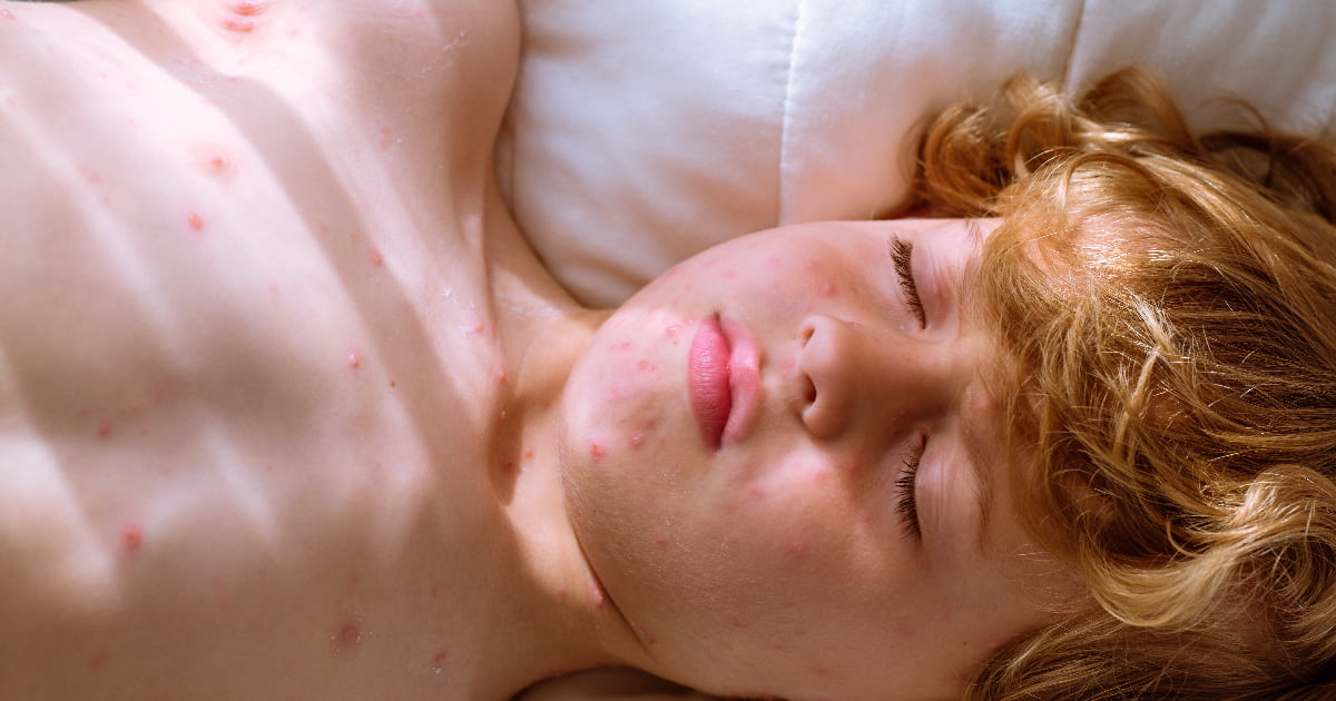 How to Get Rid of a Rash Overnight