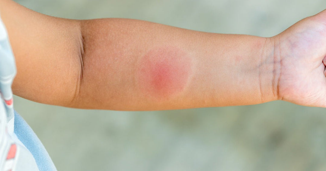 Identifying Skin Problems That Look Like Ringworm: Causes and Treatmen ...