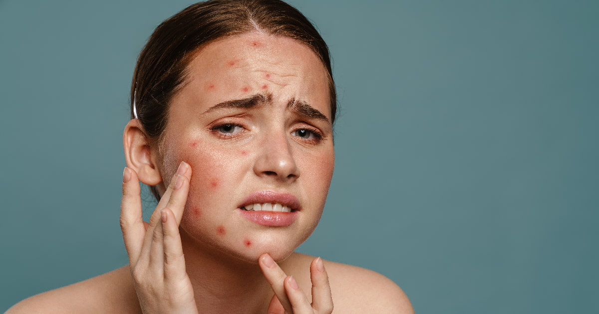 The Skin-Diet Connection: How Food Intolerances Can Affect Your Skin